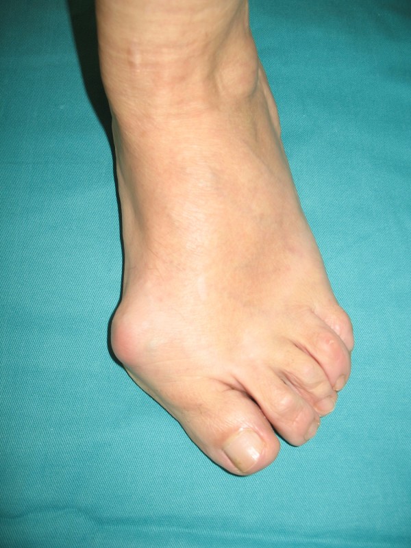 artritična zgloba tretmana stopala
