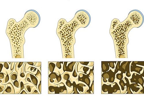 Osteoporoza – Bolest kostiju