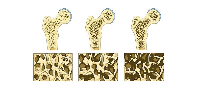 Osteoporoza – Bolest kostiju
