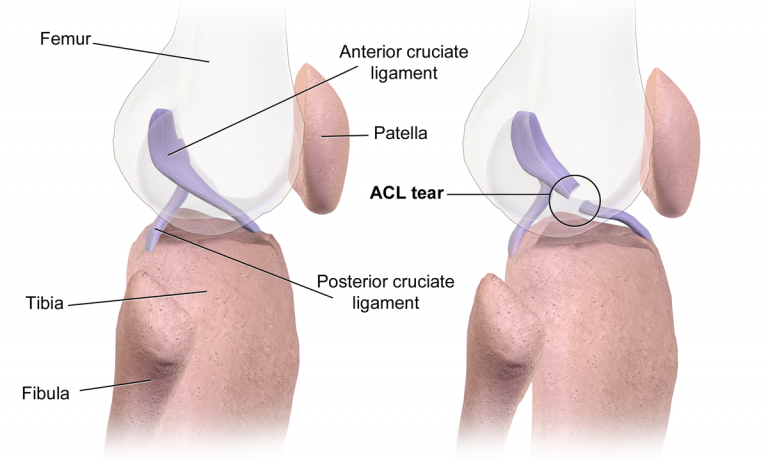 Povreda prednjeg ukrštenog ligamenta