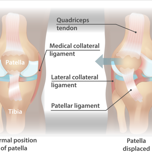 Iščašenje časice kolena: znaci, simptomi, lečenje