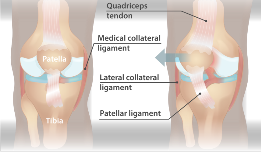 Iščašenje časice kolena: znaci, simptomi, lečenje